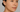 Hyperpigmentation: Causes & How GlowIQ Devices Can Help You Achieve Clearer Skin